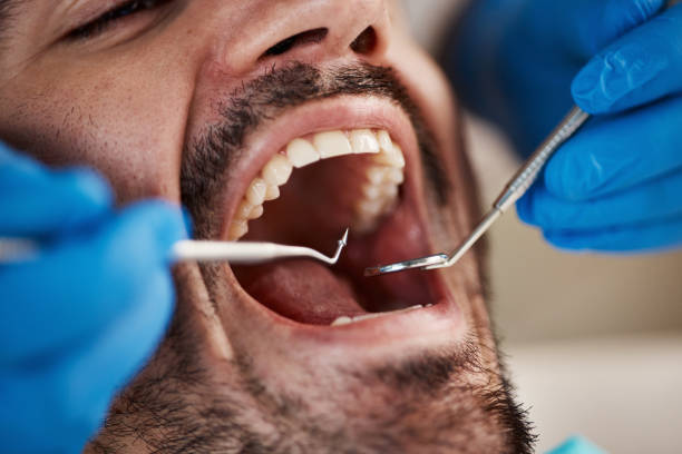 Best Broken or Chipped Tooth Repair in Owens Cross Roads, AL
